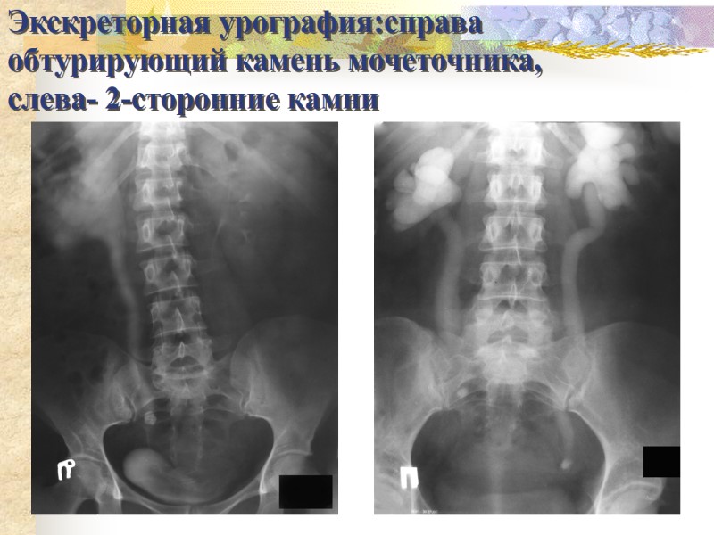 Экскреторная урография:справа обтурирующий камень мочеточника,  слева- 2-сторонние камни